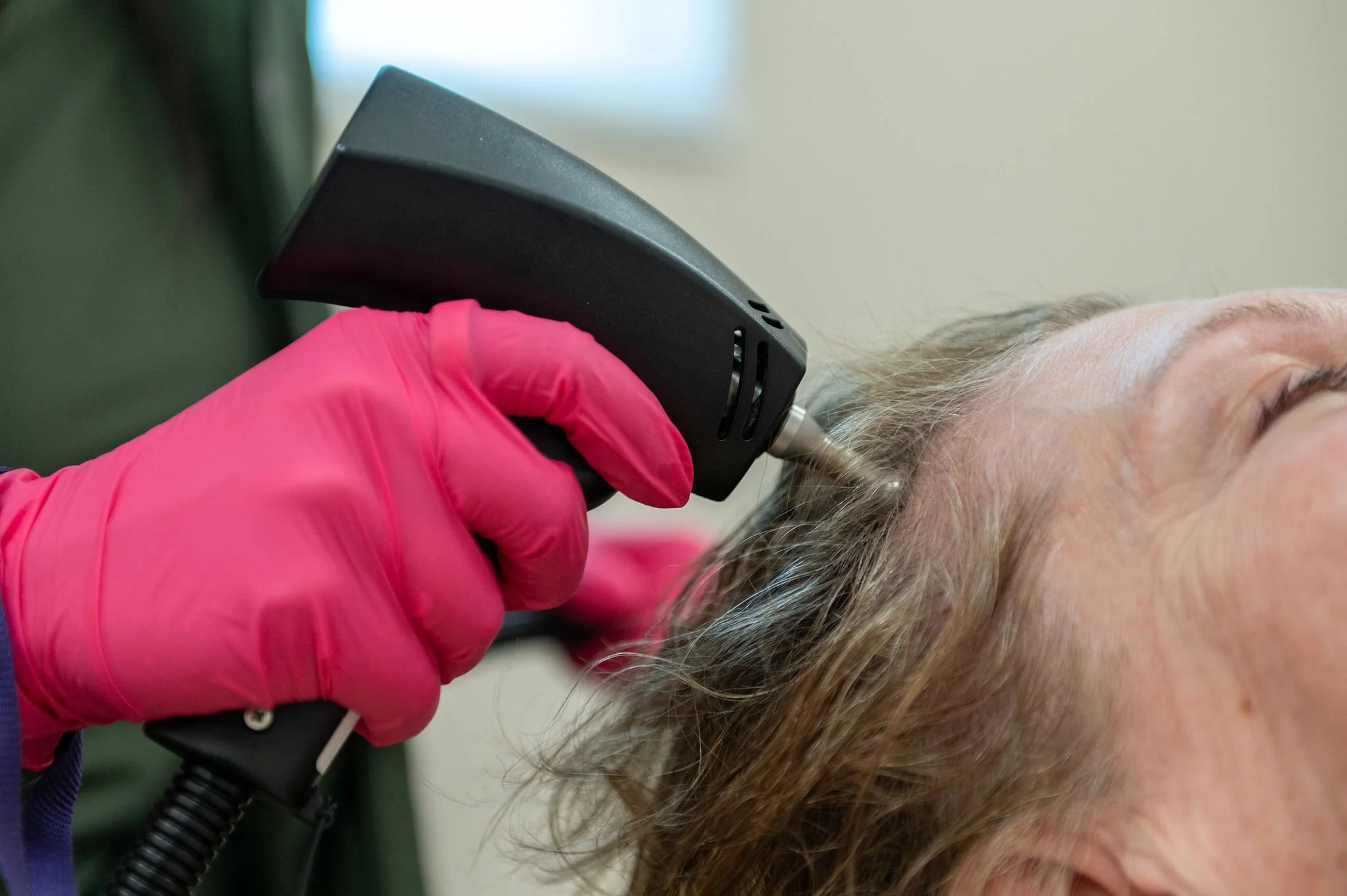 Alma TED for Hair Loss: What You Need to Know