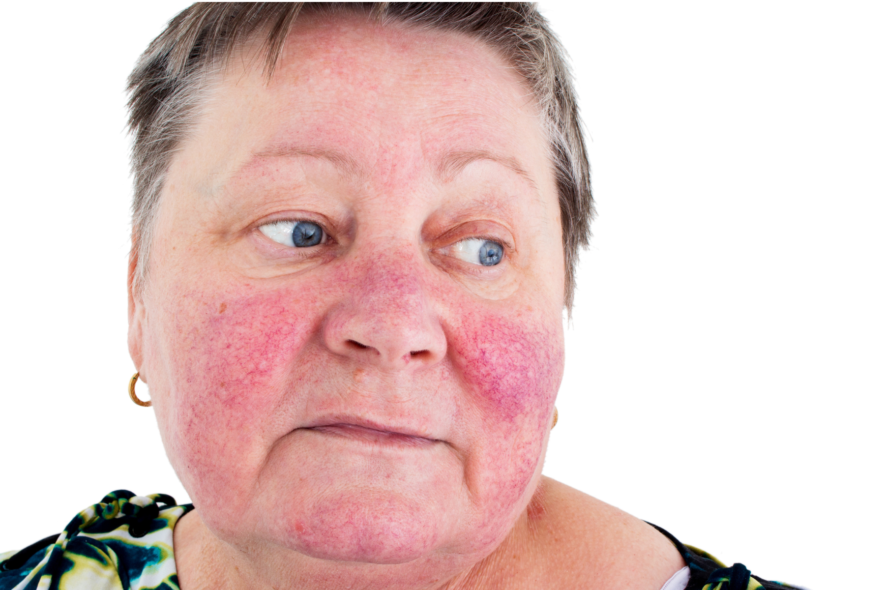Is Rosacea Causing Your Redness? Here's What Your Skin May Be Trying to Tell You