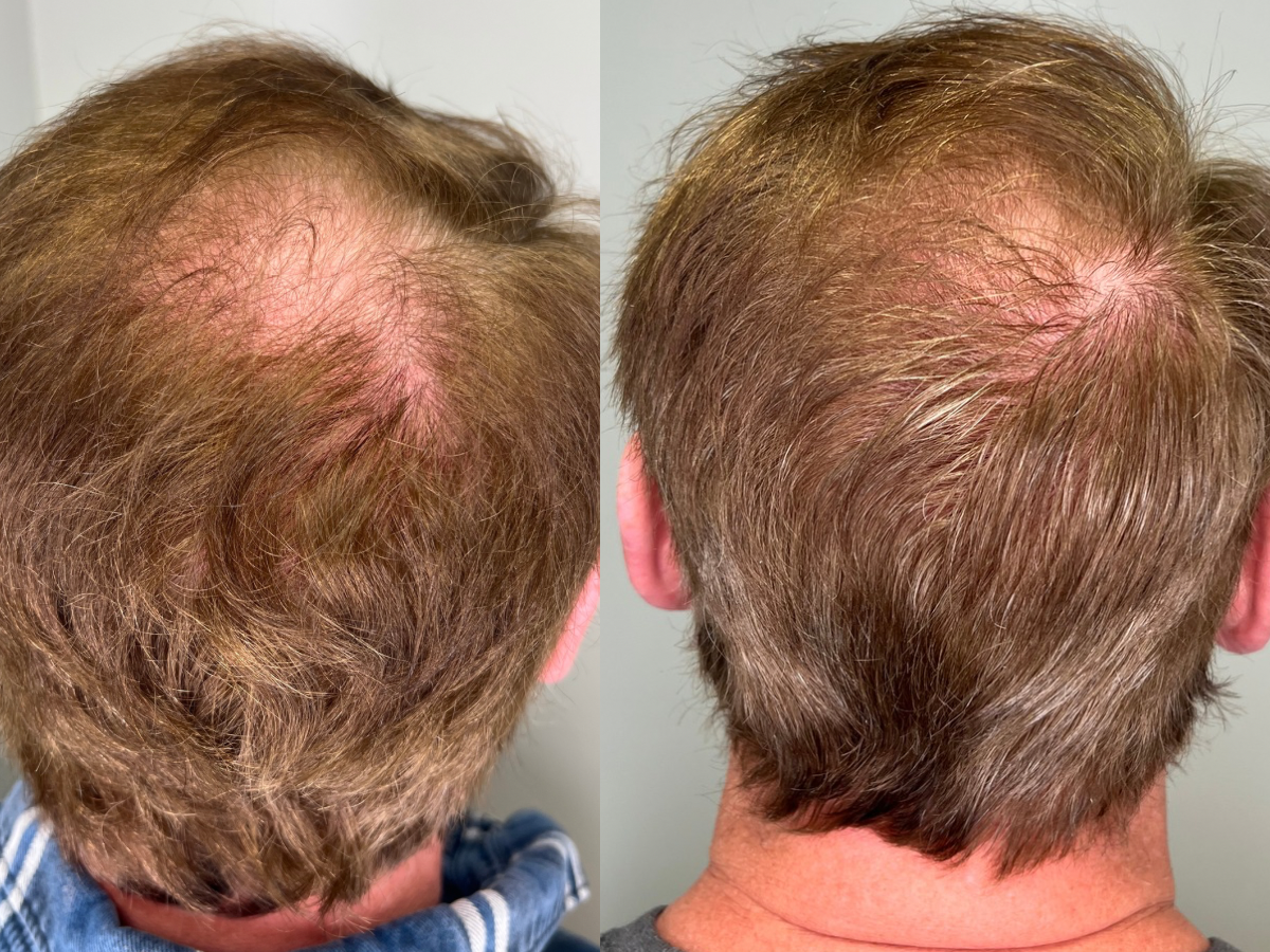 Hair Restoration for thinning hair 