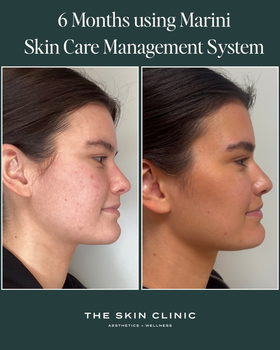 Side-by-side before and after photos showing the skin improvement after 6 months using Marini Skin Care Management System, with text at the top indicating the duration and product, and at the bottom the clinic's name, The Skin Clinic, Aesthetics and Wellness.