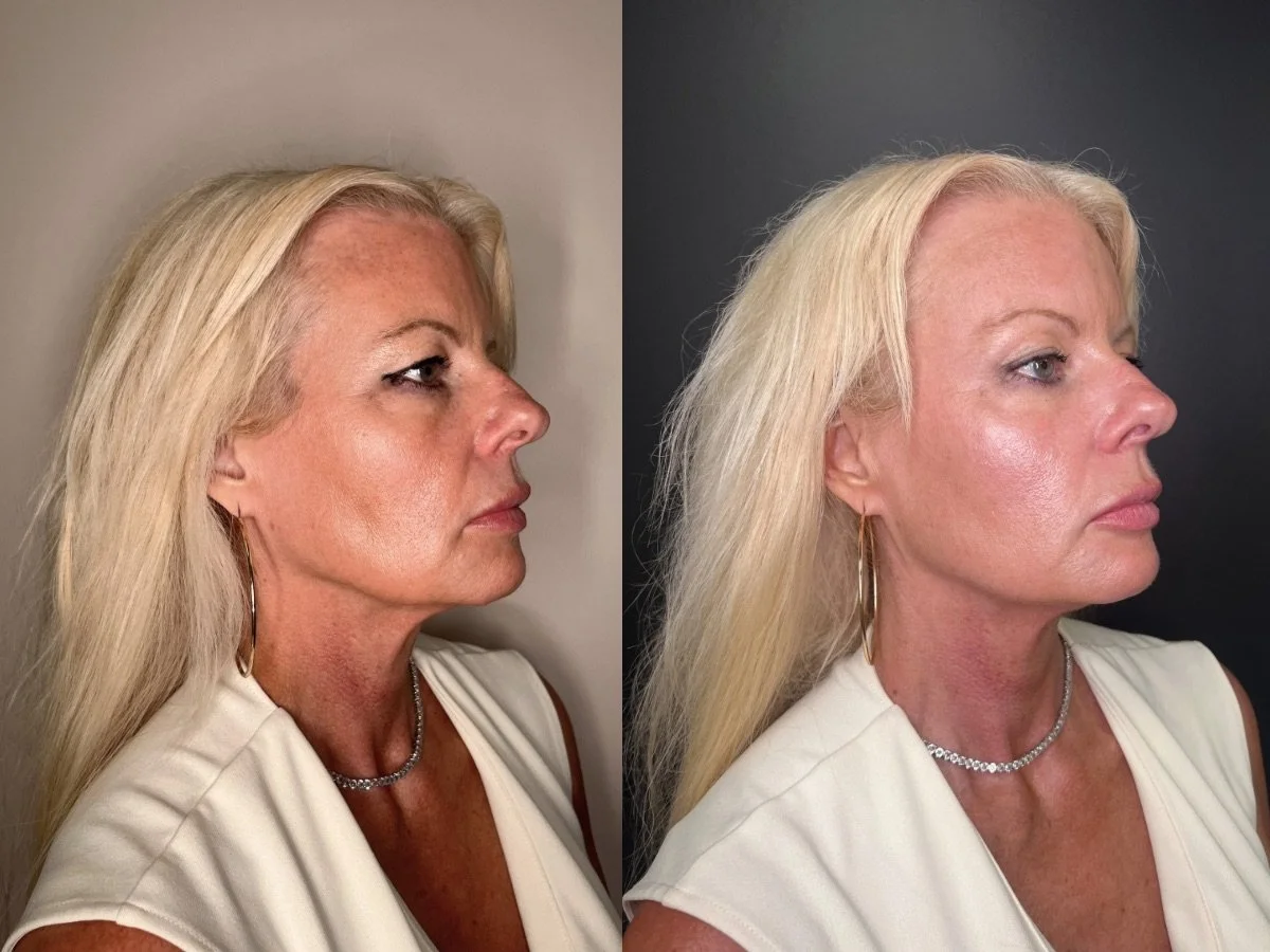 Dermal Filler Mankato, MN The Skin Clinic 