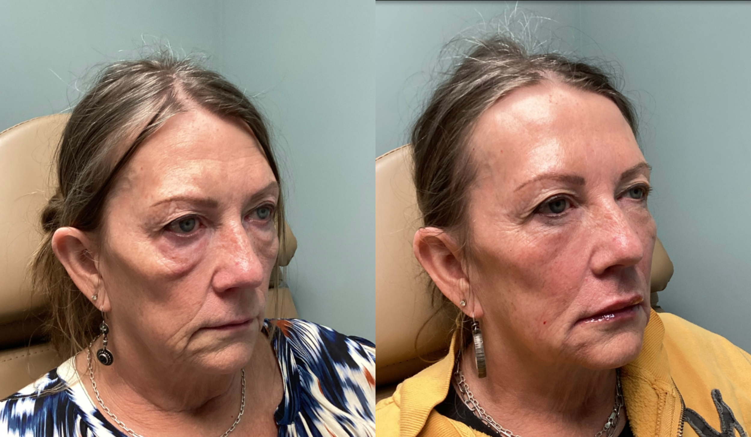 Before and after images of a woman showing facial improvements, seated in a medical or clinical setting.