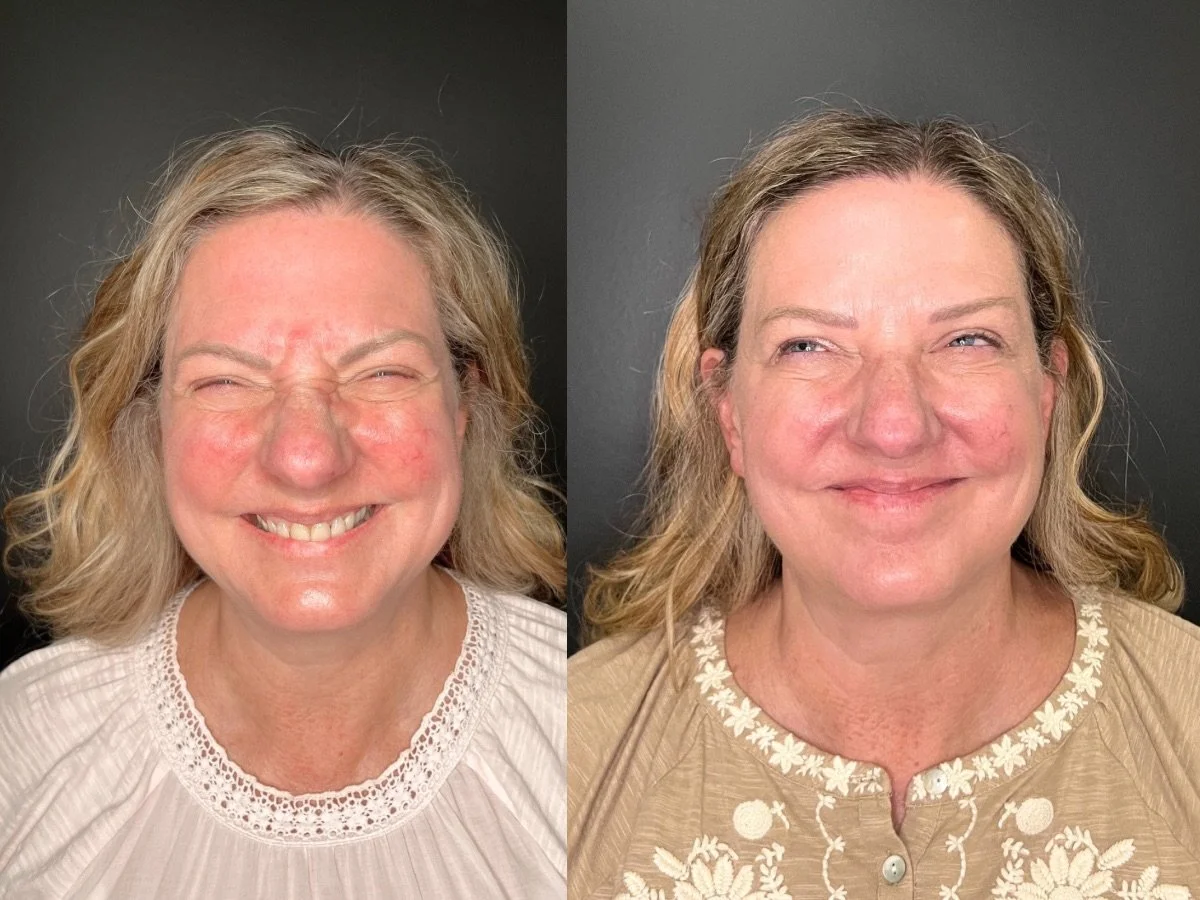 Botox lower face treatment 
