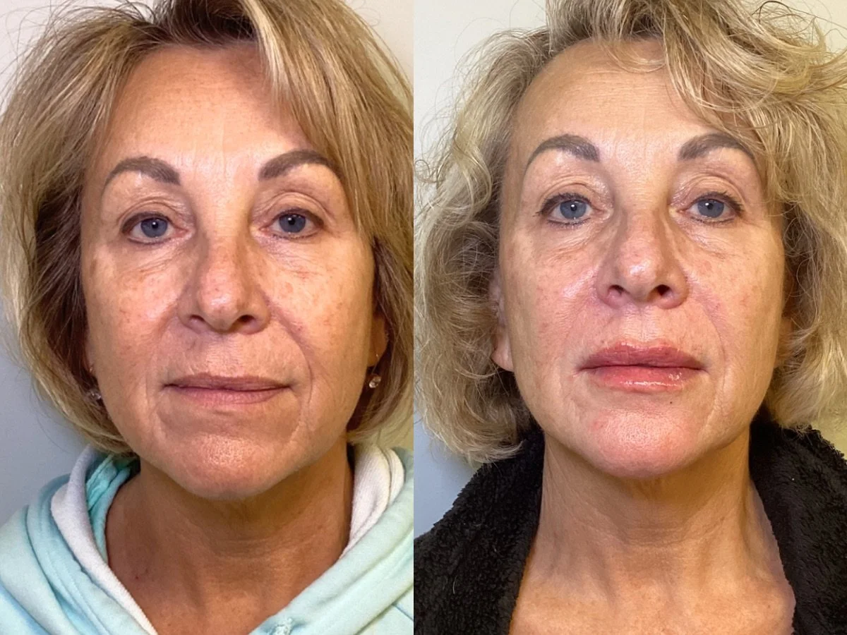 Comparison of a woman's face before and after a cosmetic treatment, showing reduced redness and improved skin texture.