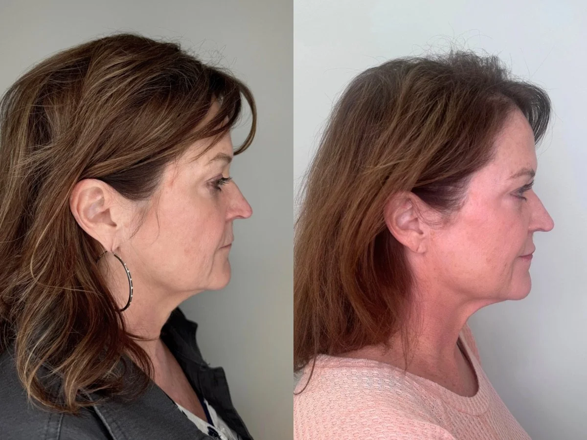 Emface Non Surgical Facelift, the skin clinic, Mankato