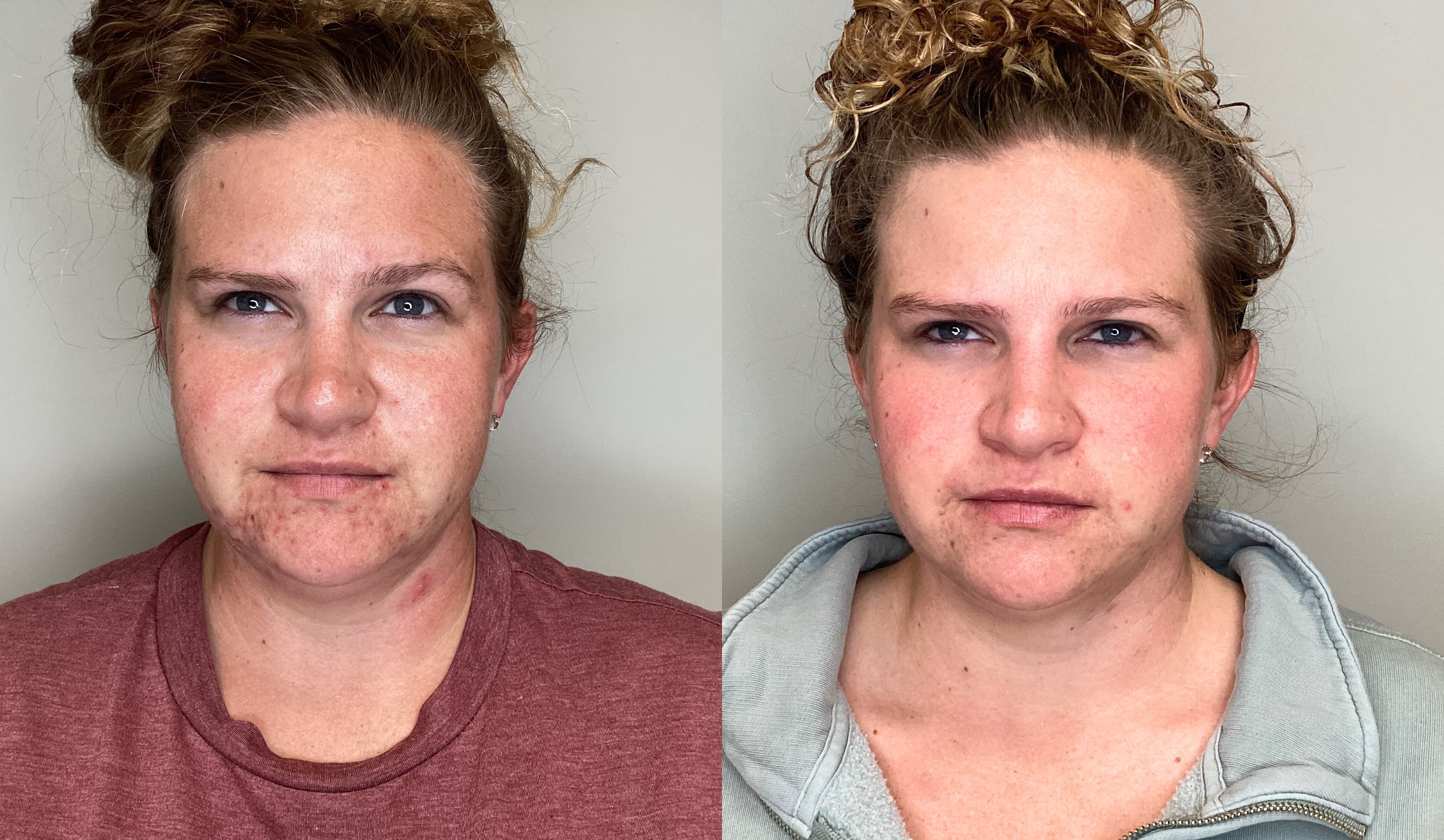 Side-by-side comparison of a woman with acne on the left and clear skin on the right, both with curly hair and neutral expression.