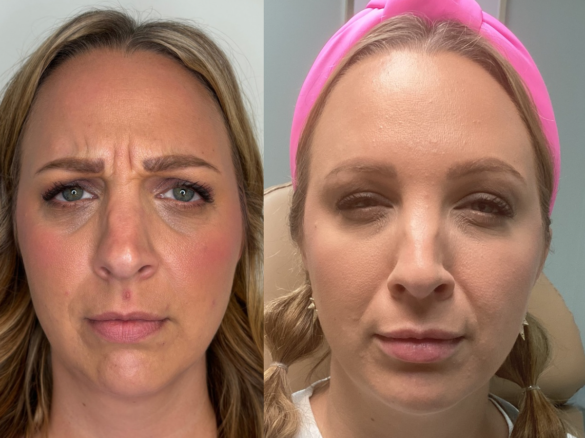 BOTOX TREATMENT 