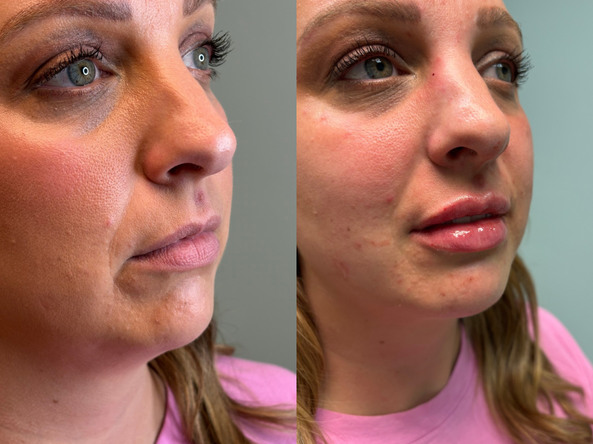 LIP FILLER MANKATO, MN