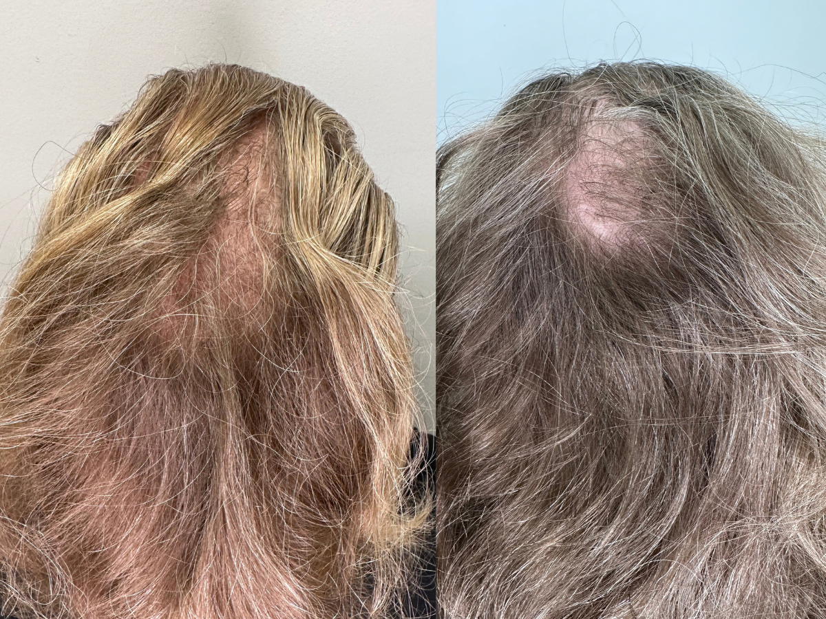 Comparison of two top-view images of a person's scalp, showing hair thinning or hair loss on the crown area.