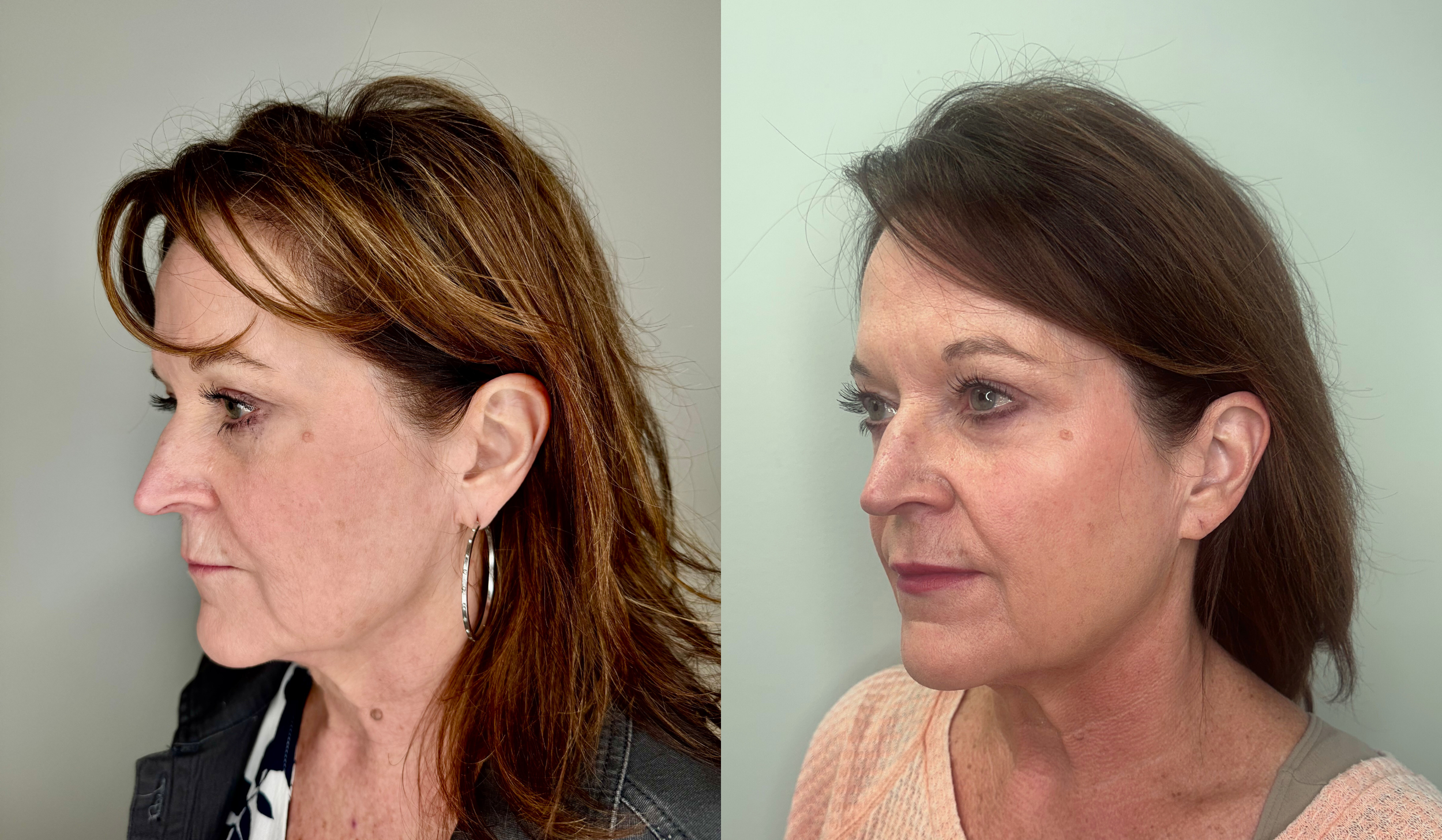 Side-by-side comparison of the same woman, before and after a cosmetic procedure, with the woman having different hairstyles and clothing in each photo.