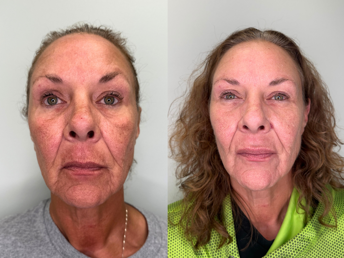 Side-by-side comparison of a woman before and after skincare or cosmetic treatment, showing improved skin texture and appearance.