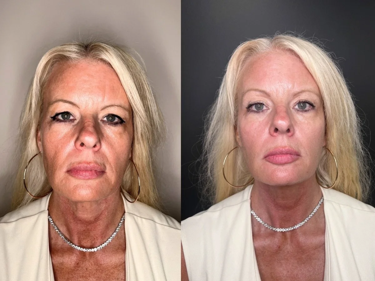 Dermal Filler Mankato, MN The Skin Clinic