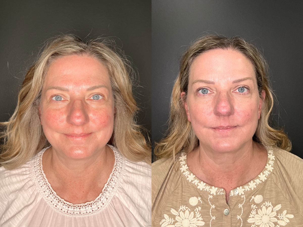 Side-by-side comparison photo of a woman before and after skincare or makeup treatment, with clear skin and a confident expression.