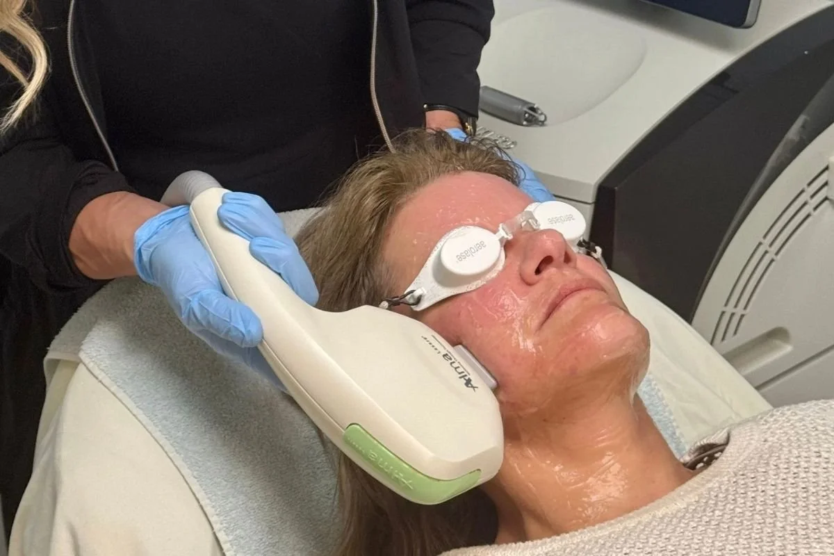 IPL PHotofacial, Mankato, MN, The SKin CLinic