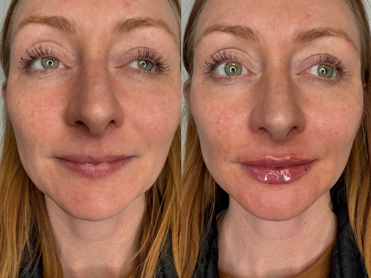 Lip Filler 