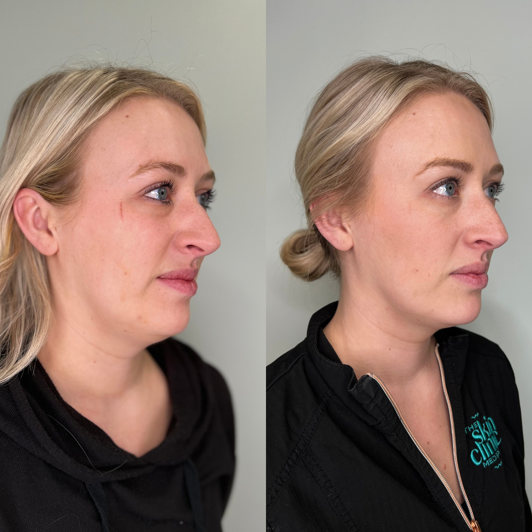 Side-by-side comparison of two women, showing before and after images of a cosmetic procedure, with clear skin and well-defined facial features, wearing black clothing, set against a plain background.