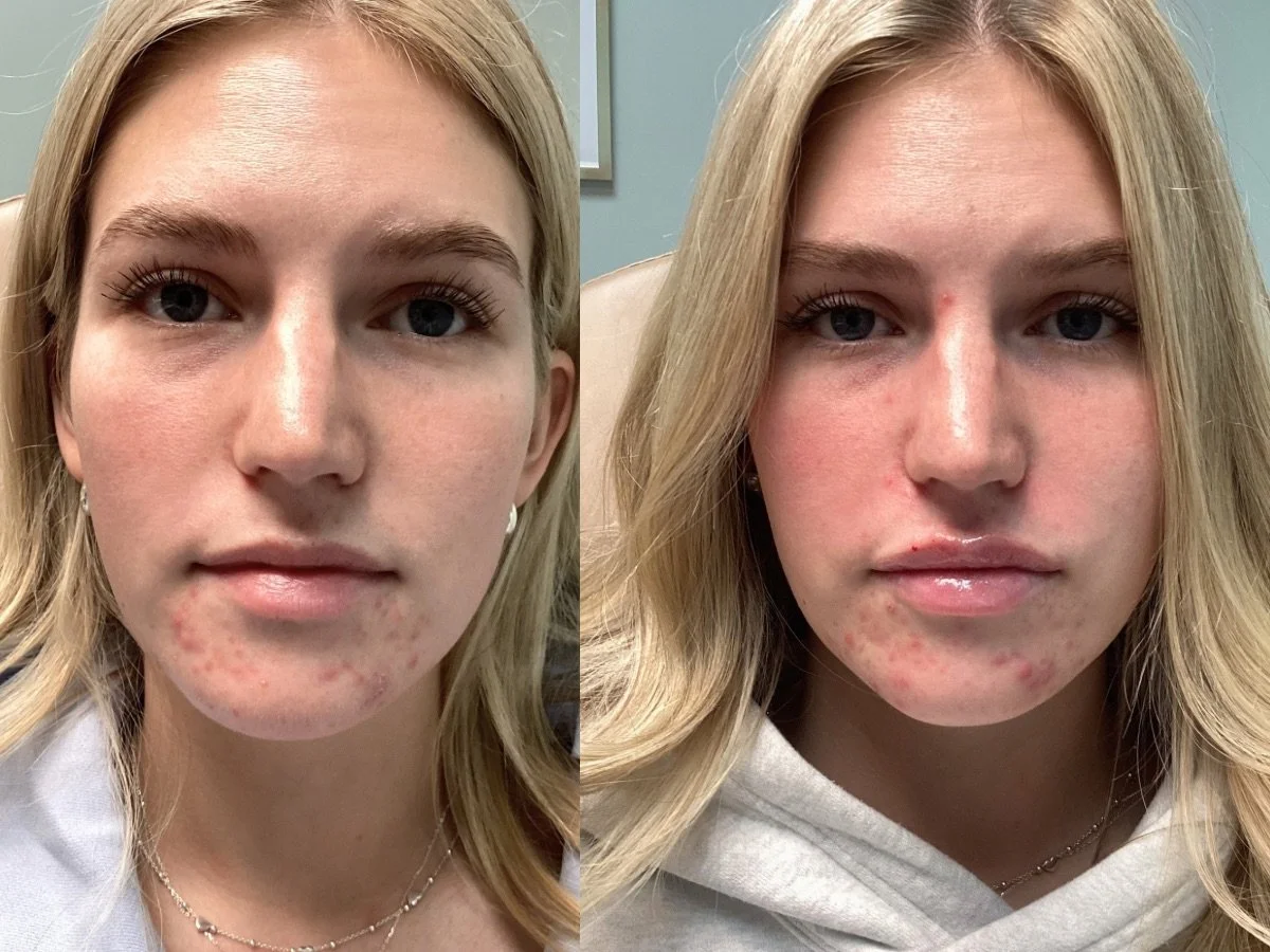 Lip Filler Mankato, MN