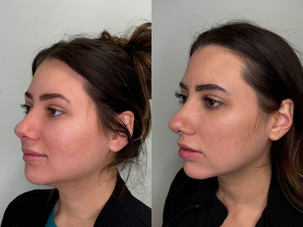 Comparison of a woman's face before and after a cosmetic treatment, showing smoother skin and refined features on the right.