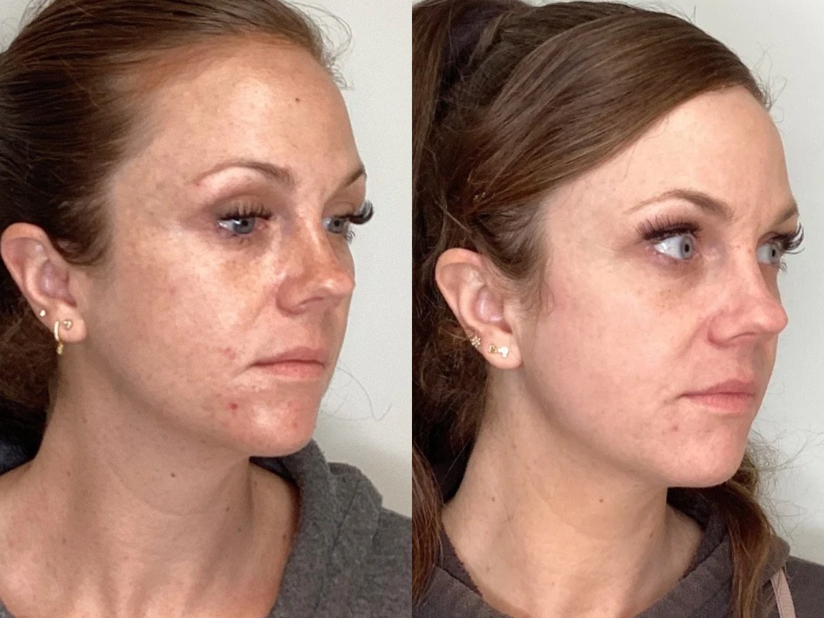 Laser Treatment, Skin Clinic, Mankato