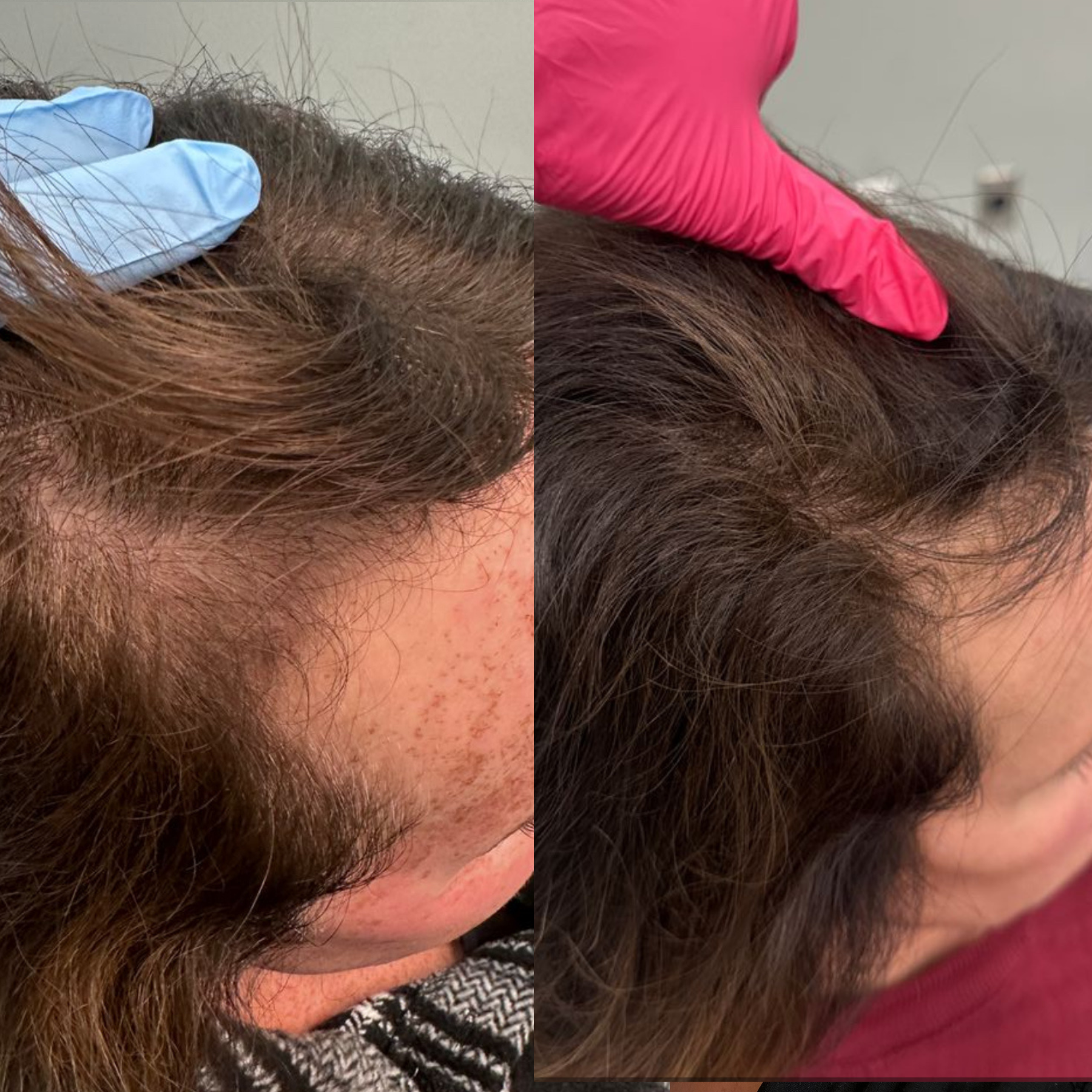 Comparison of scalp hair, showing improved hair density and health after treatment with before (left) and after (right) pictures, with a person wearing a pink glove on the scalp.
