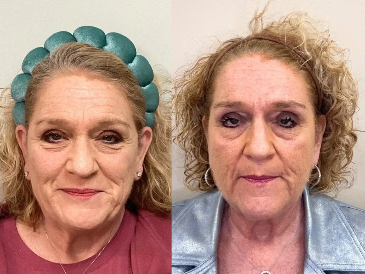Emface Non Surgical Facelift, the skin clinic, Mankato