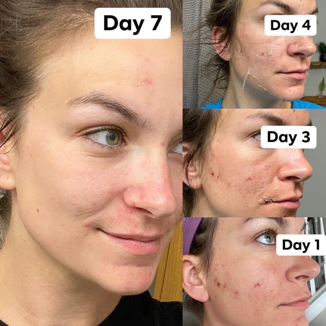 VI Peel for acne, wrinkles, sun damage, pigment, dull skin 