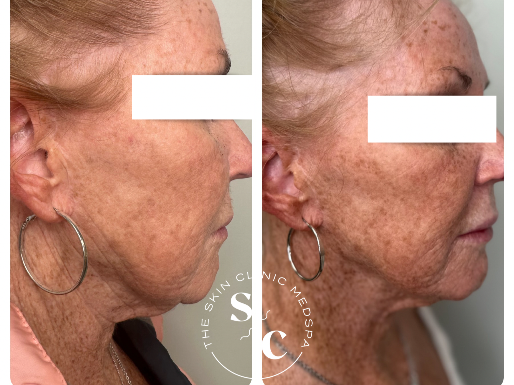 EMFACE BEFORE AND AFTER