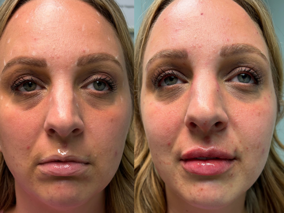 LIP FILLER 