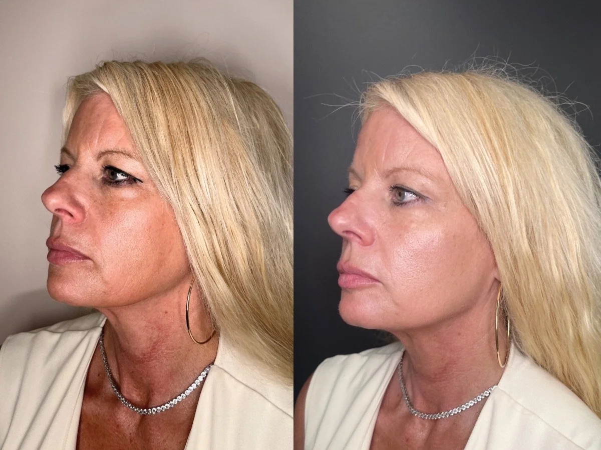 Dermal Filler Mankato, MN The Skin Clinic