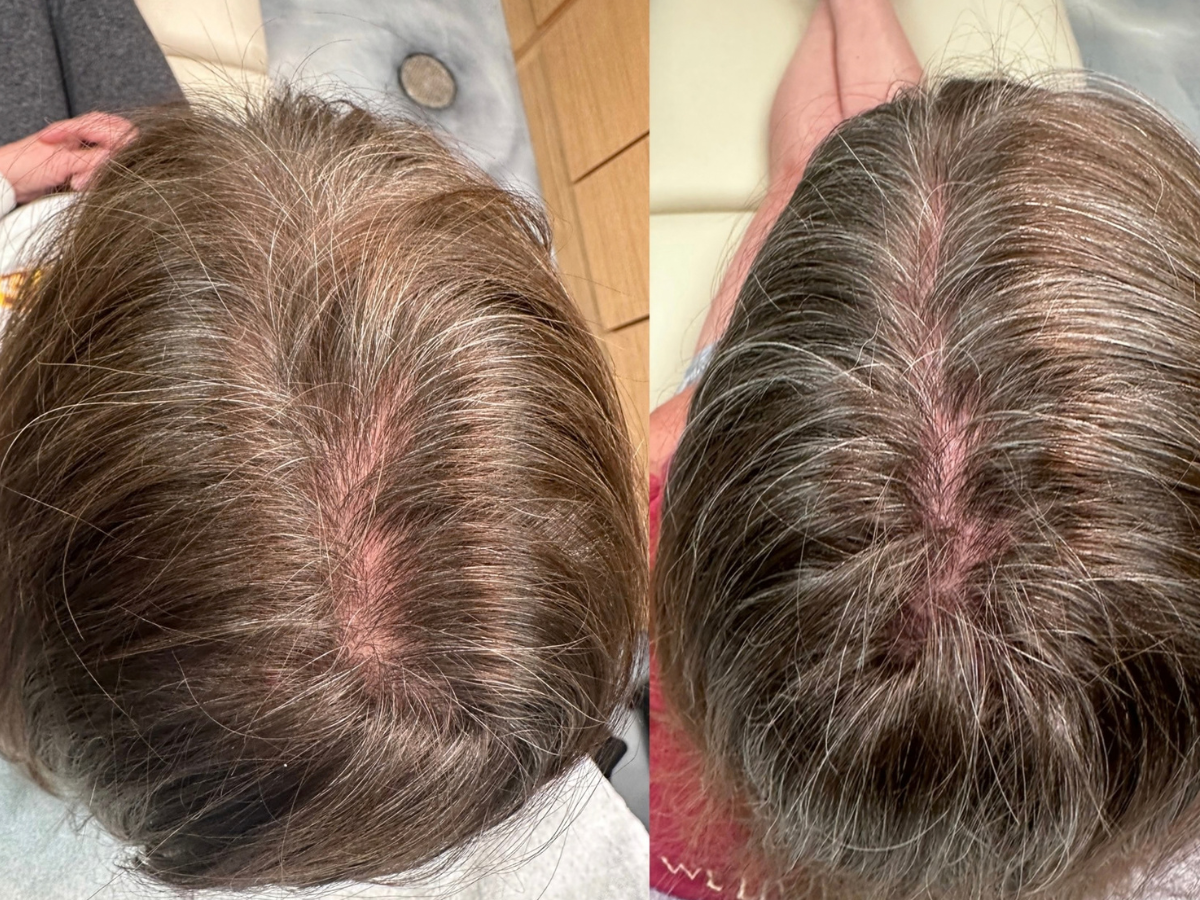 Top view of a person's scalp showing graying hair, with a before-and-after comparison of hair growth or hair treatment.