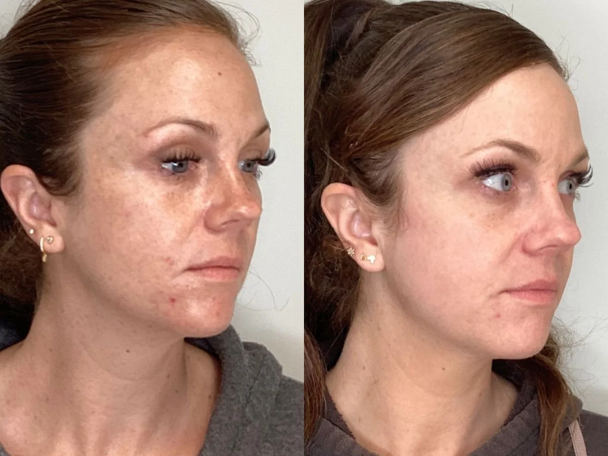 C02 Laser Treatment at the Skin Clinic Med Spa, Mankato, Mn