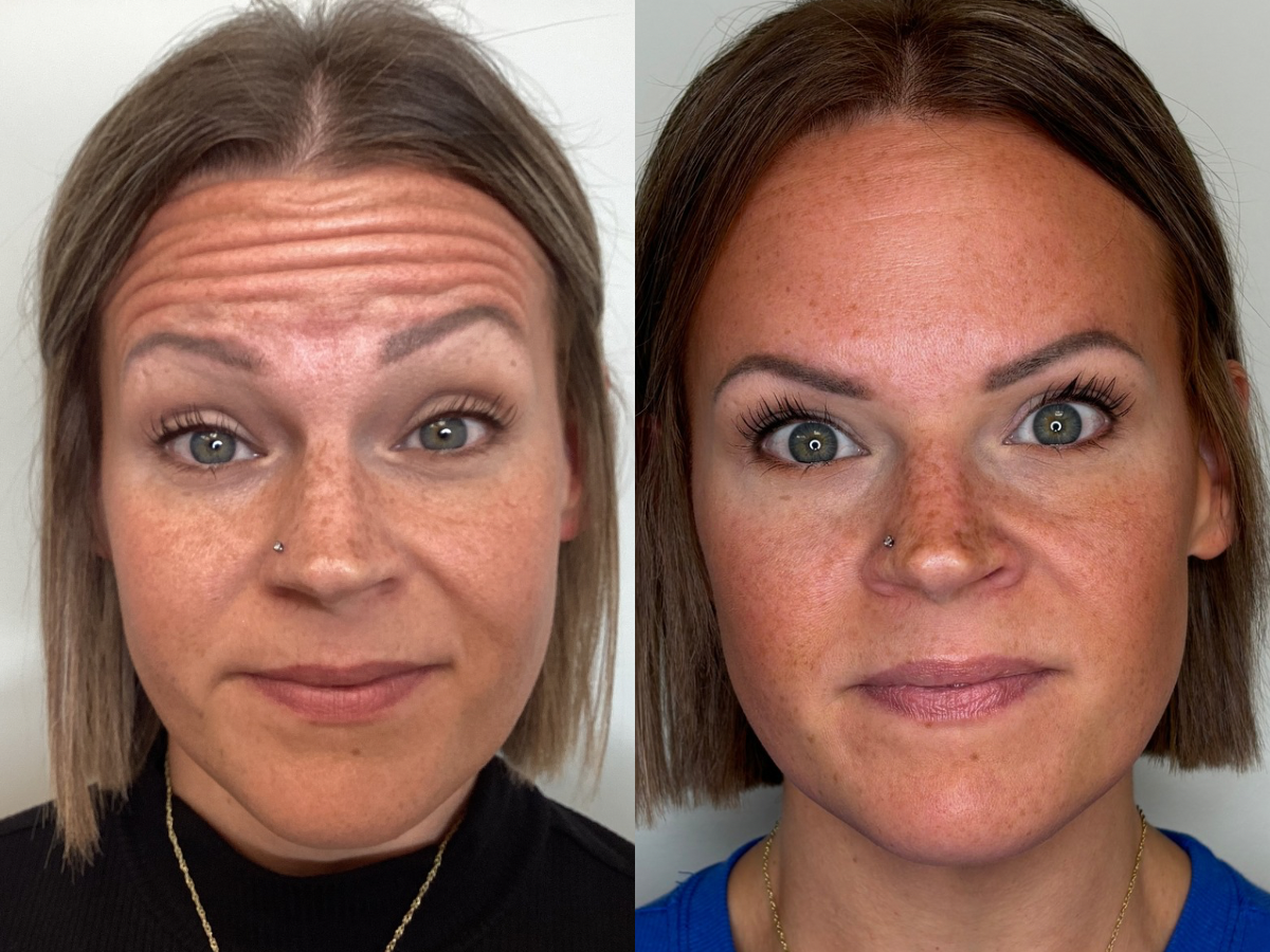 Botox treatment