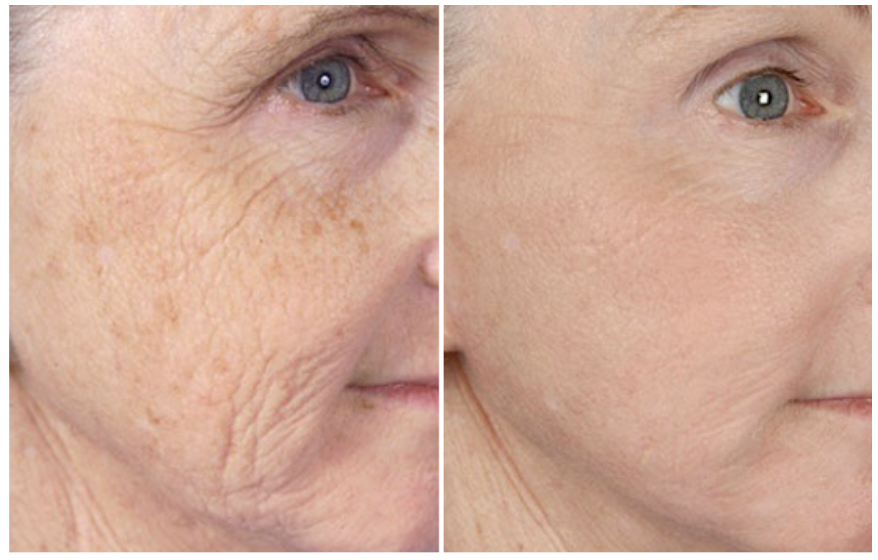 Side-by-side comparison of a woman's face showing skin with wrinkles and age spots on the left, and smoother, clearer skin on the right.