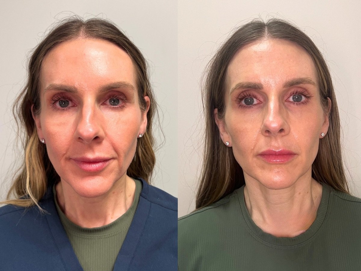 Dermal Filler Mankato, MN The Skin Clinic