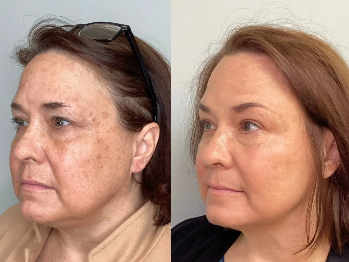 Side-by-side comparison of a woman with acne on the left and clear skin on the right, both with curly hair and neutral expression.