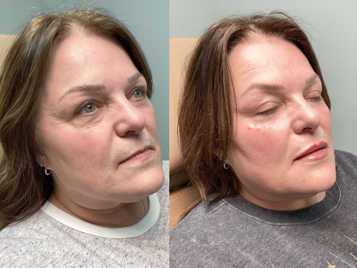 Lip Filler Mankato, M