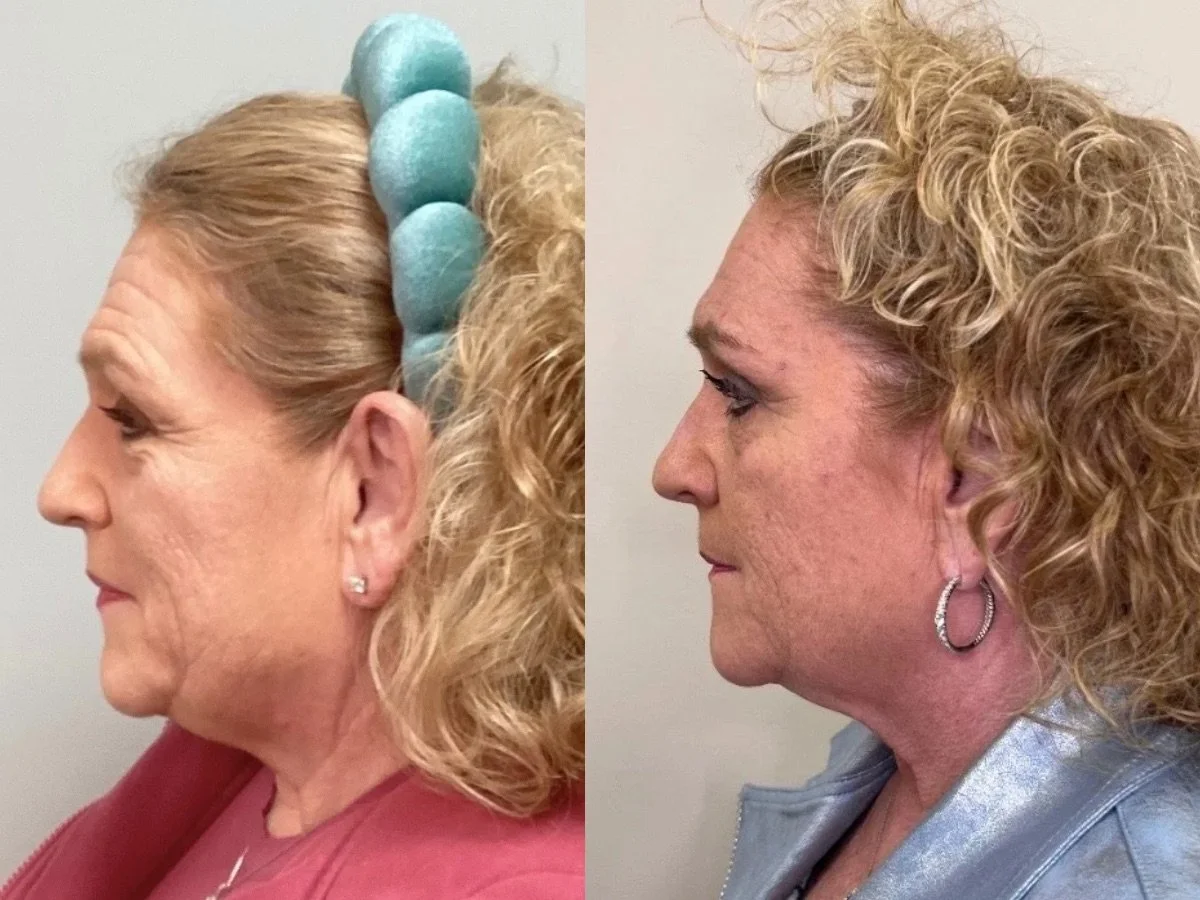 Emface Non Surgical Facelift, the skin clinic, Mankato
