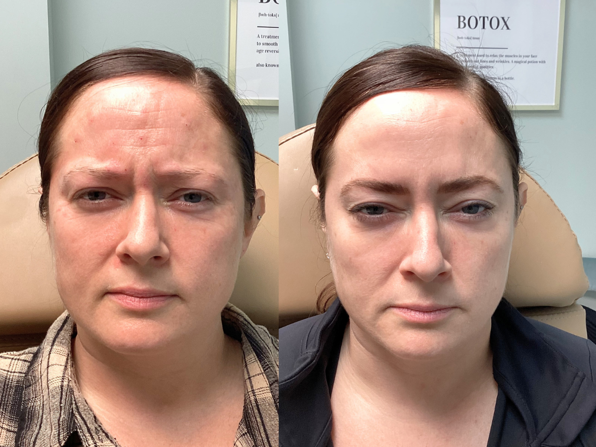 Comparison of a woman's face before and after receiving Botox treatment, with signs on the wall in the background.