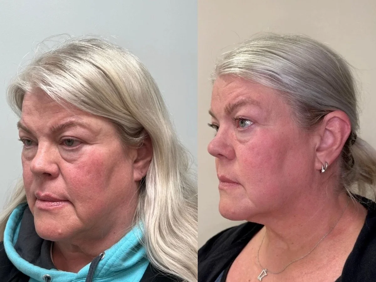 Emface Non Surgical Facelift, the skin clinic, Mankato