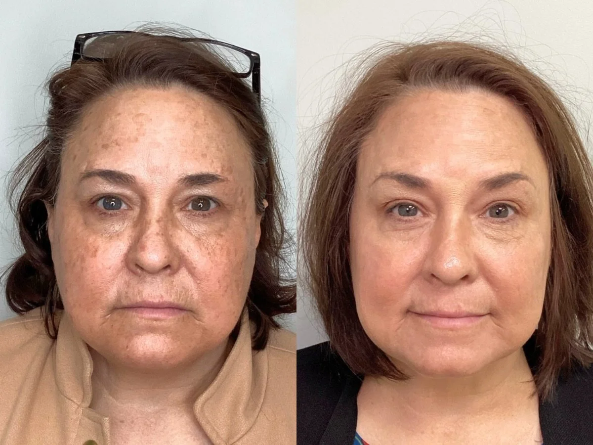 IPL BBL PHOTOFACIAL Mankato, mn