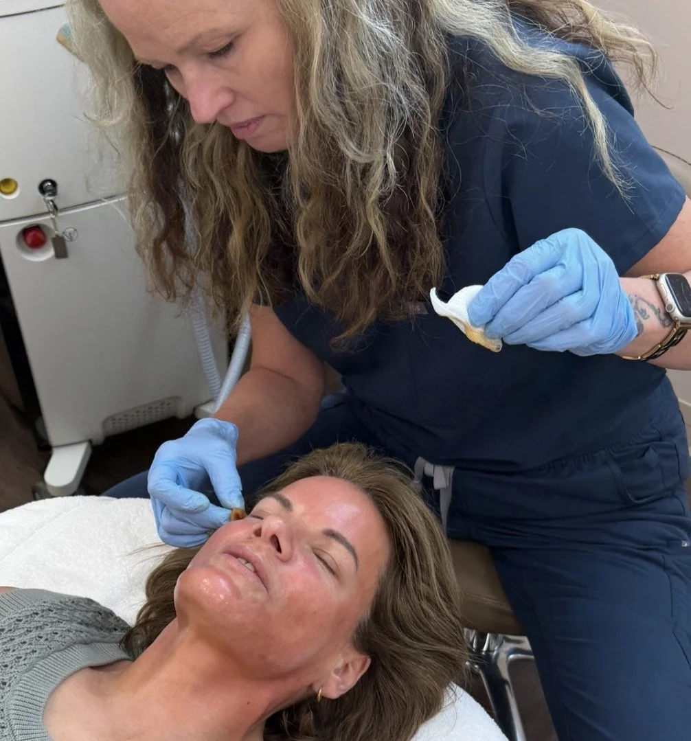 VI Chemical Peel, Mankato, MN