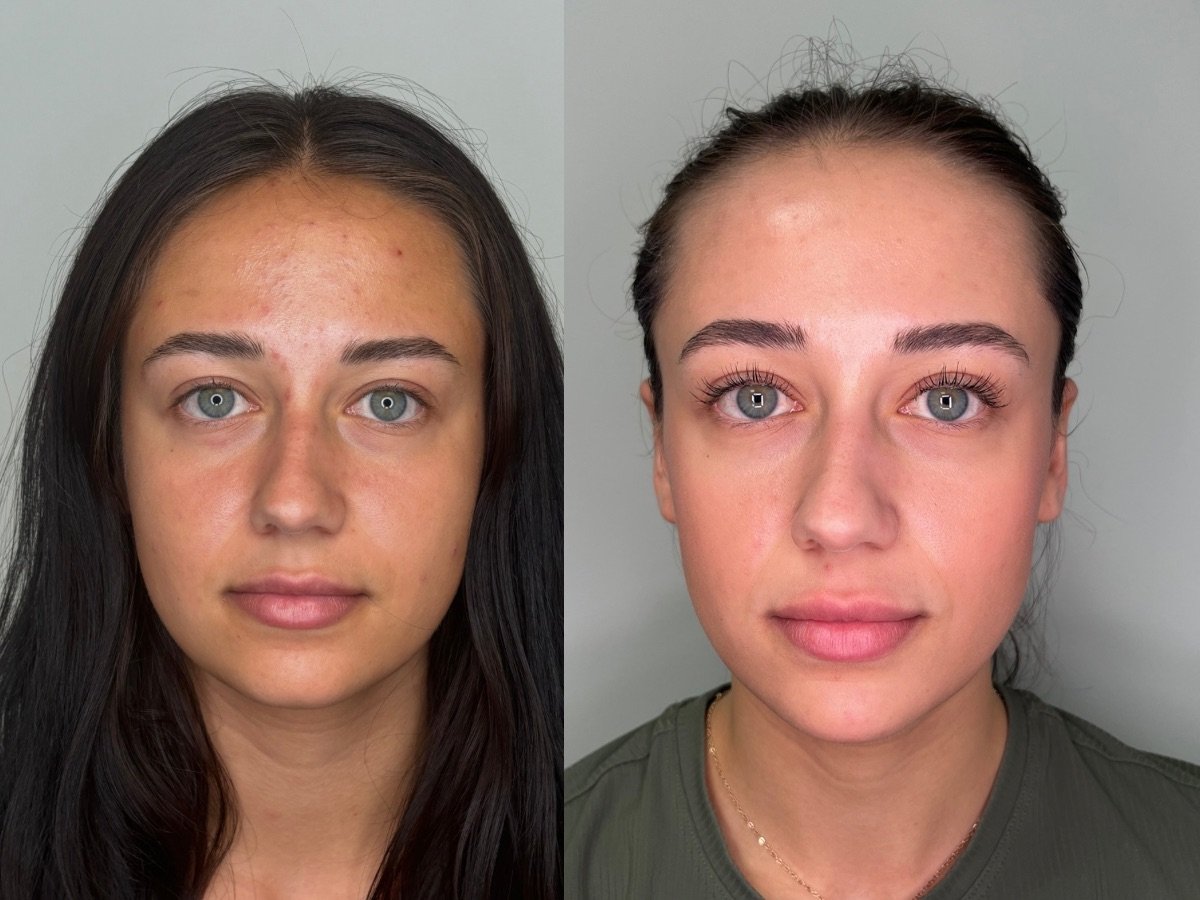 skin improvement after skin care, less acne