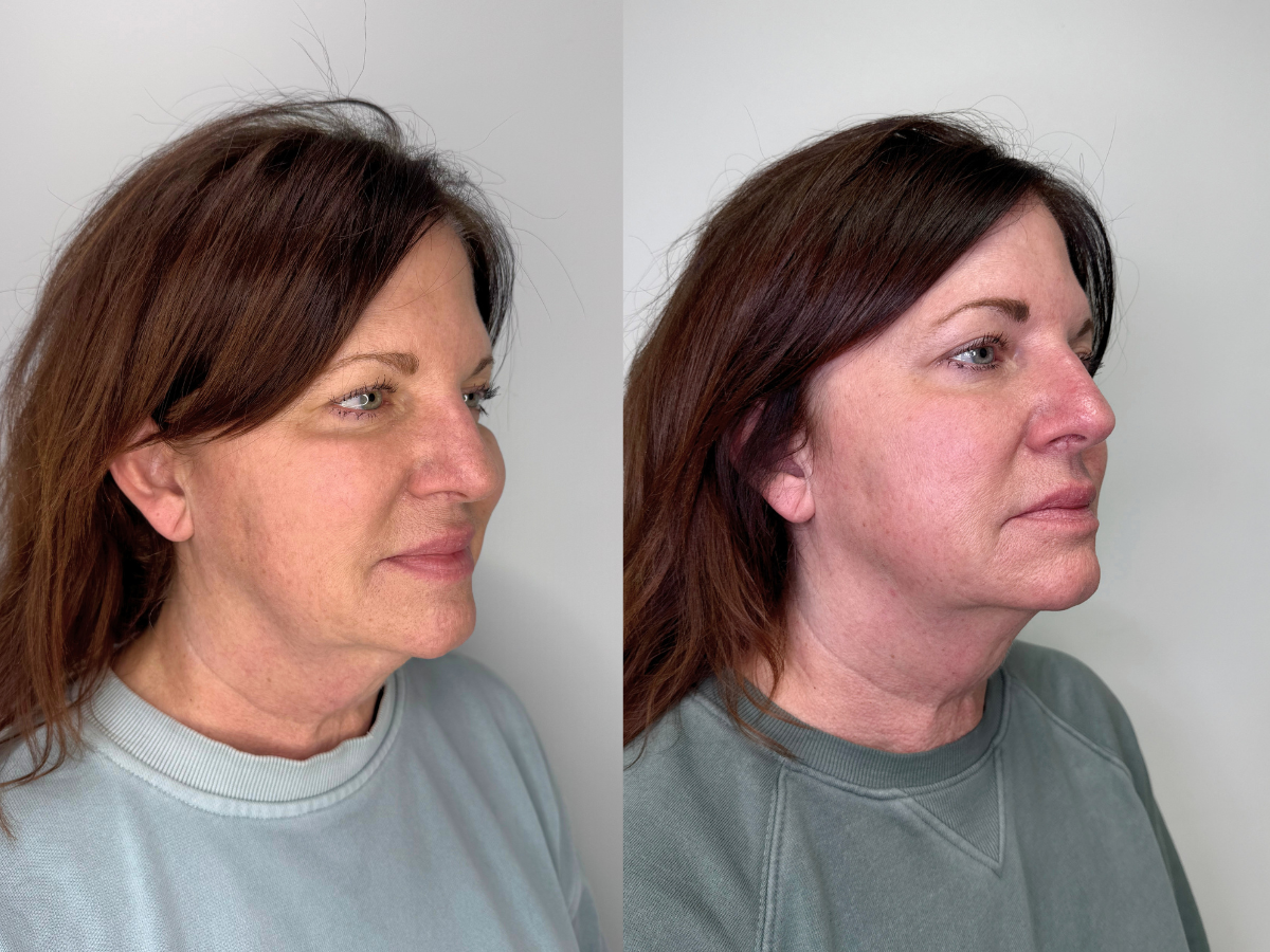 Side-by-side before and after photos of a woman showing skin improvements following a skincare treatment.