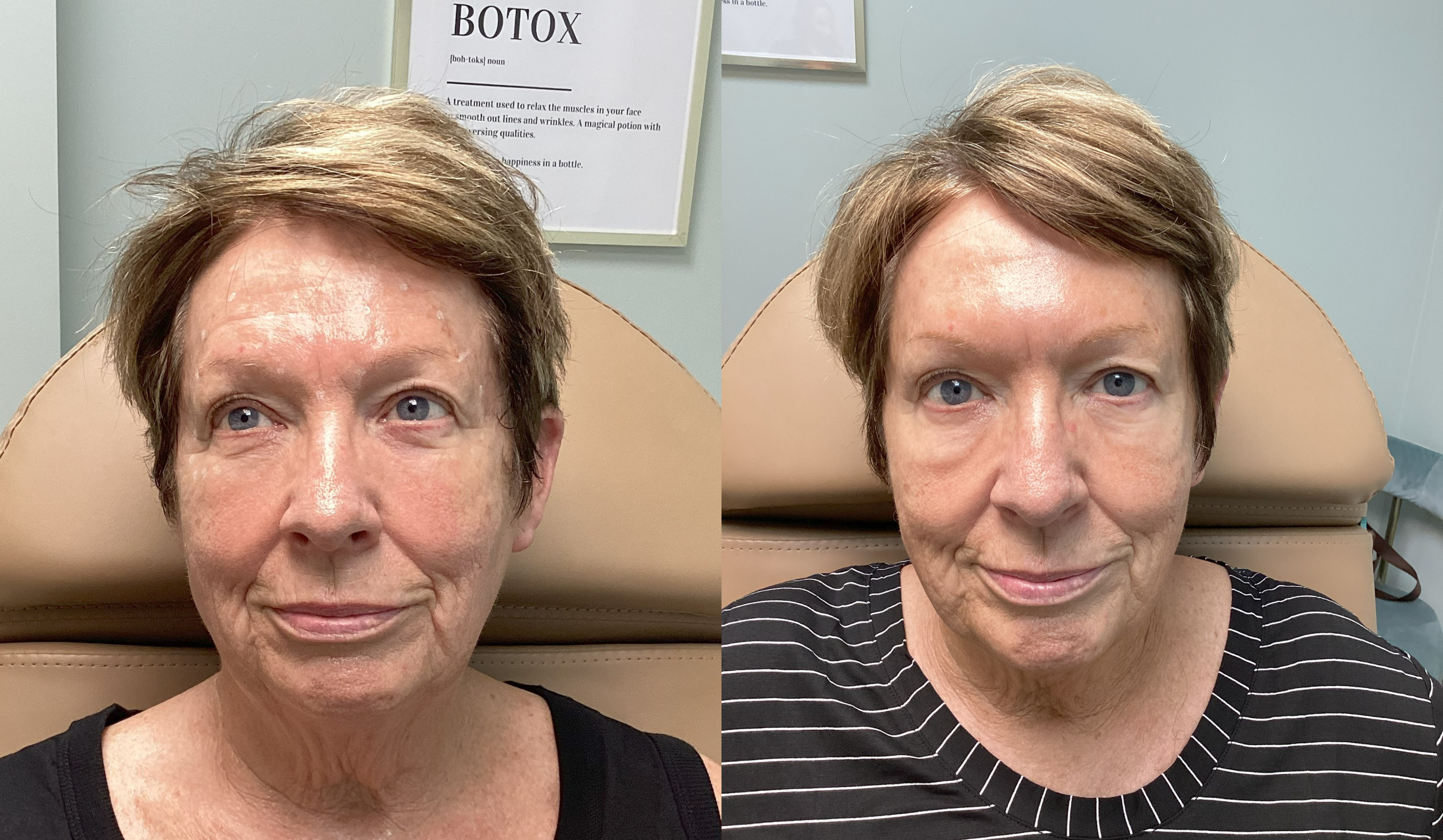 Side-by-side before and after photos of a middle-aged woman with short light brown hair and blue eyes, in a medical setting. In the before photo, her face appears slightly puffy and wrinkled. In the after photo, her face looks more contoured, smoother, and rejuvenated, indicating she has received Botox treatment.