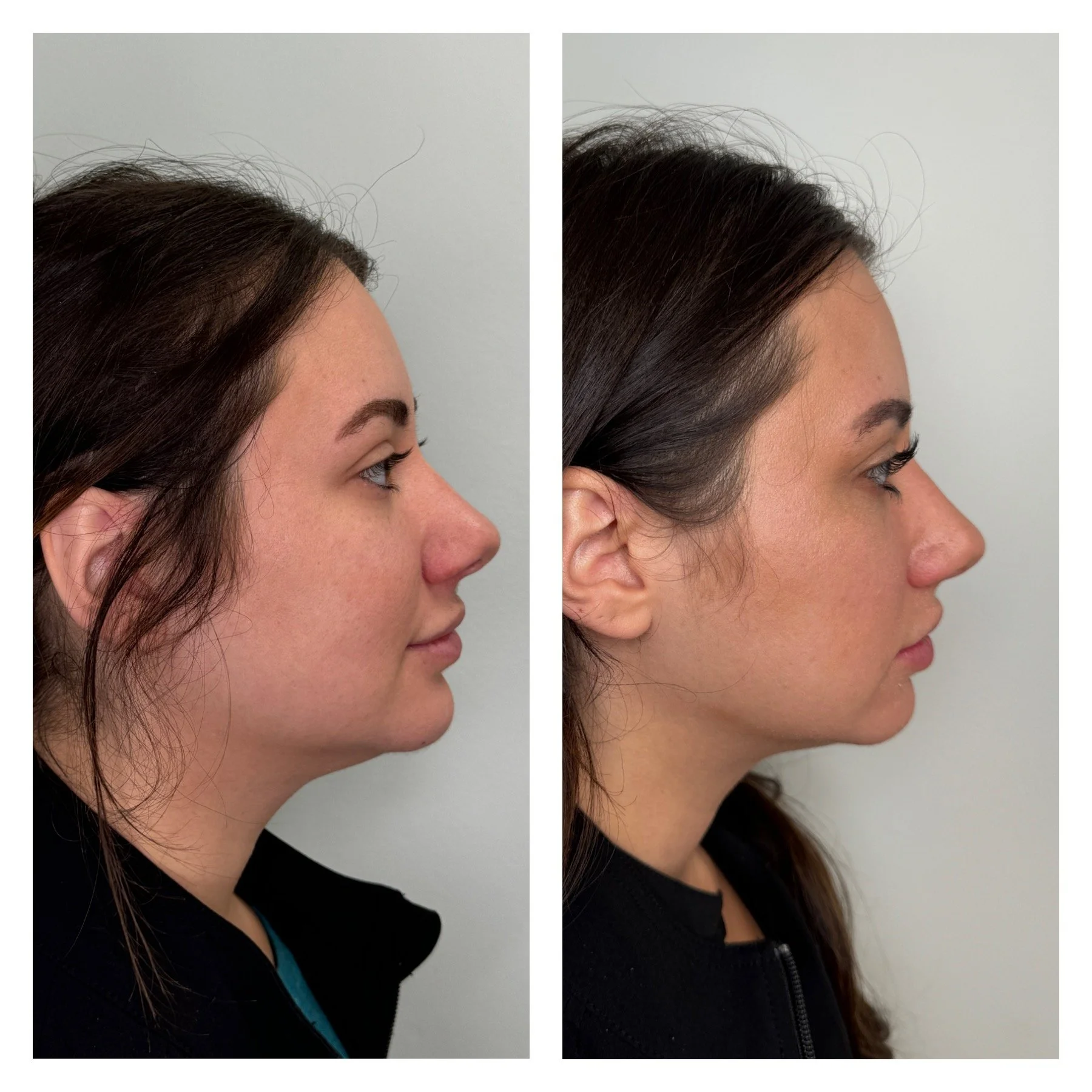 Side profile of a woman with dark brown hair, showing slight hair thinning before and after hair restoration.