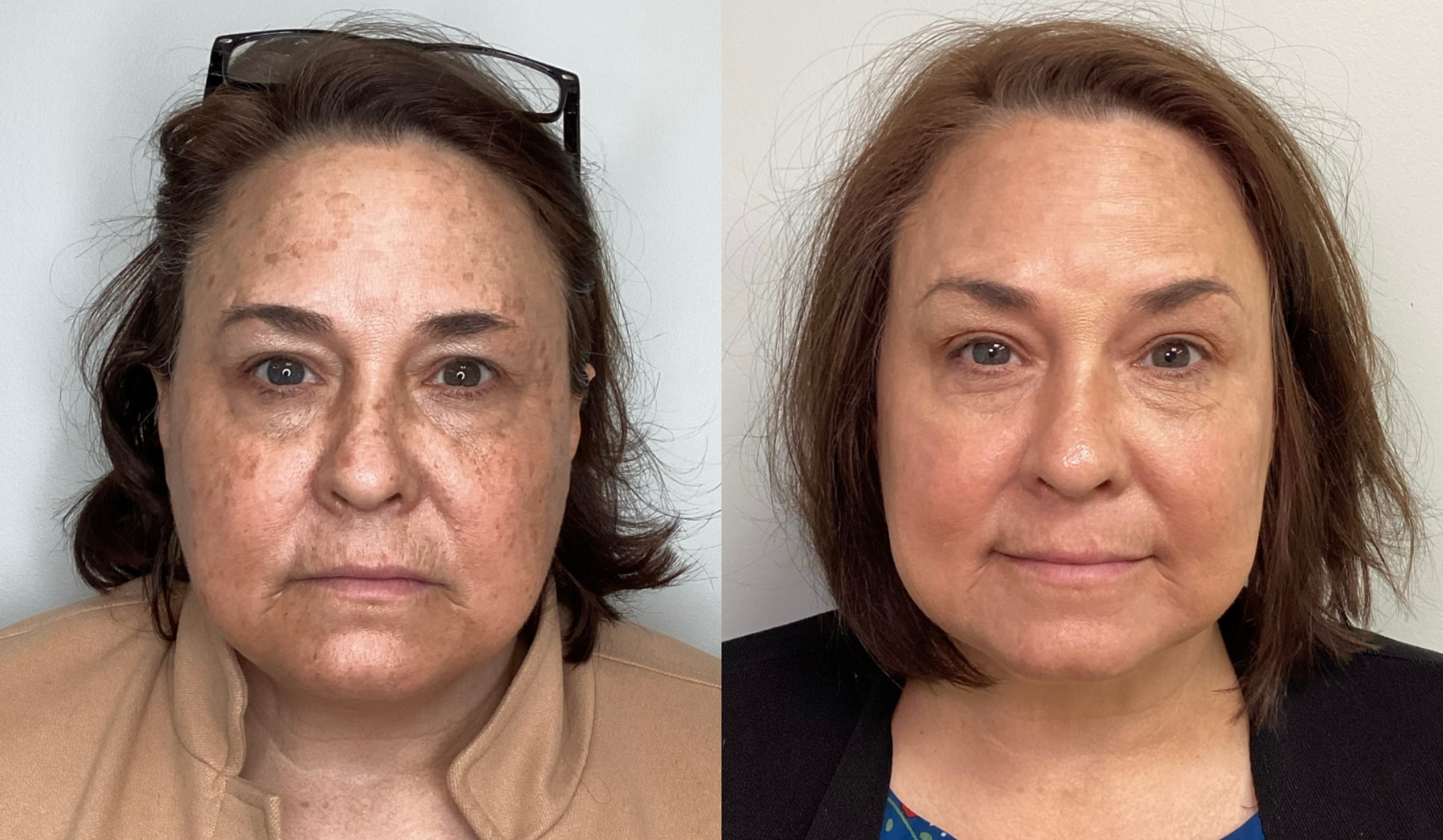 Side-by-side comparison of a woman before and after skincare treatment, showing improvement in skin texture, tone, and clarity.
