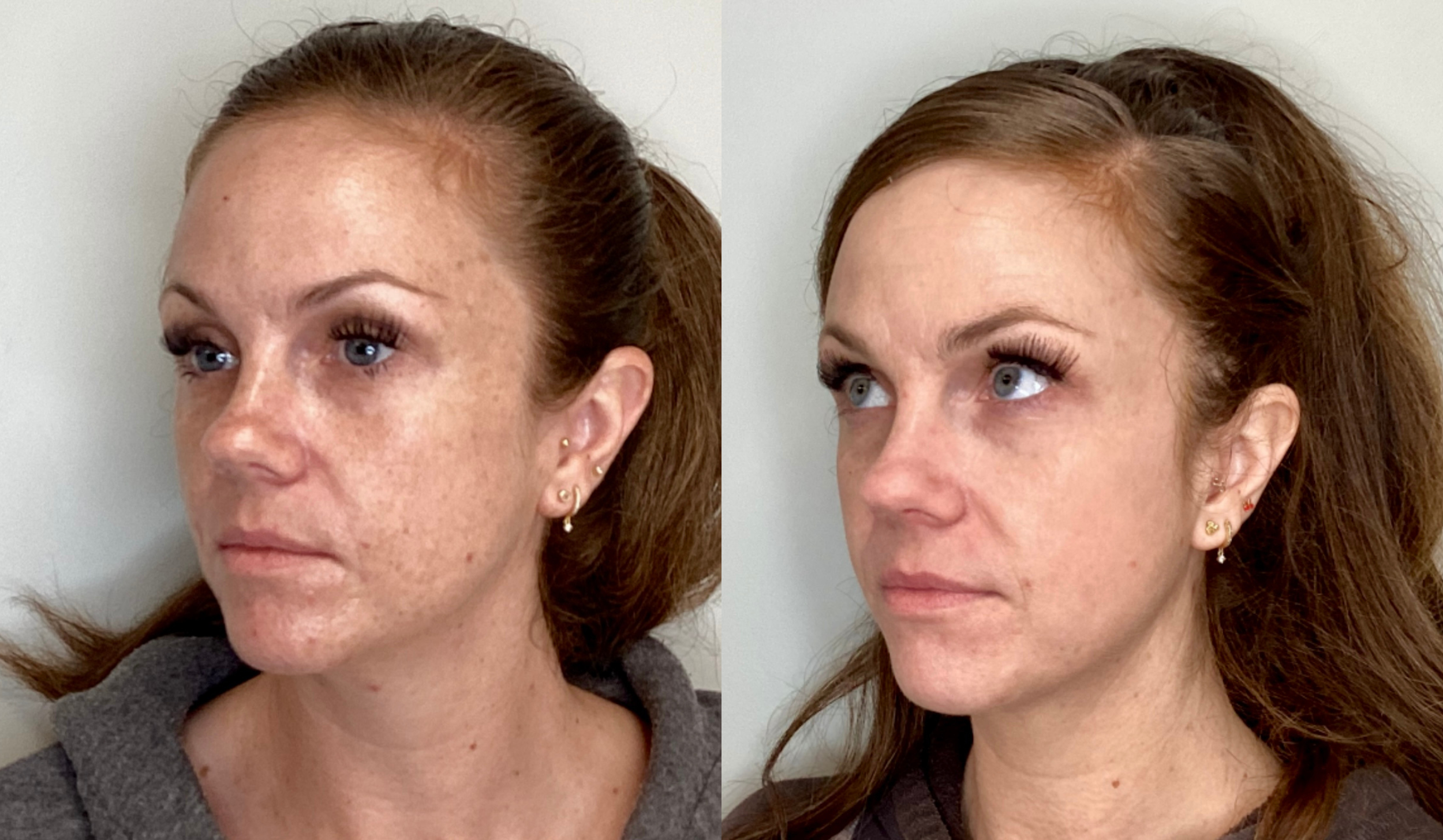 Side-by-side comparison of a woman before and after skincare, showing improved skin texture and clarity.