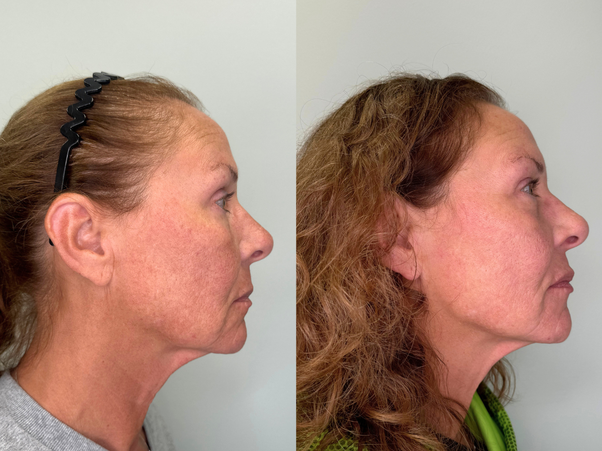 Side-by-side comparison of a woman's face before and after a cosmetic procedure, showing improved skin tone and texture.