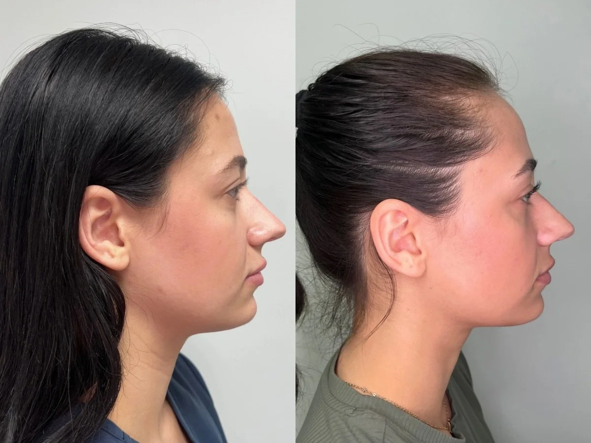 Emface Jawline Treatment, the skin clinic, Mankato