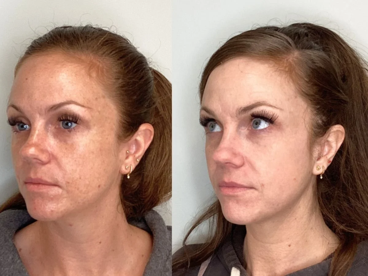 C02 Laser Treatment at the Skin Clinic Med Spa, Mankato, Mn